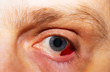 Hemorrhage of the eye, rupture of a vessel in the eye, blood in the eye