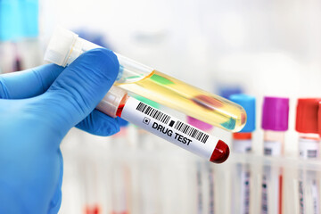 Hand doctor holding urine and blood tube test for analysis for doping or drugs. Doctor's hand with...