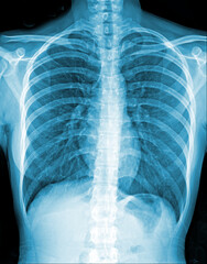 Chest x-ray film of patient for a medical
