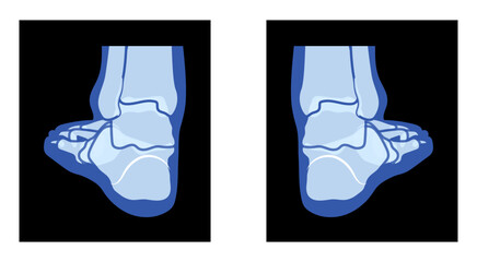 X-Ray Foot Legs Skeleton Human body Bones - malleolus, Phalanges adult people roentgen back view. Realistic flat blue color concept Vector illustration of medical anatomy isolated on black background