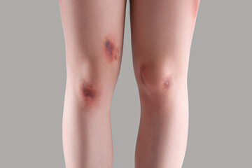 Young woman with bruised legs on grey background, closeup