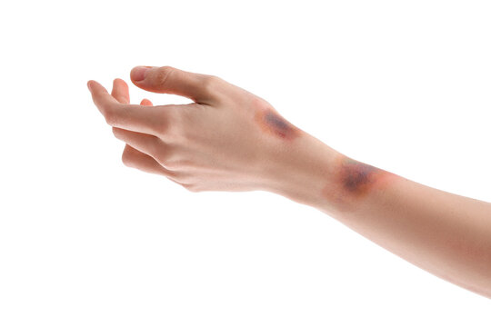 Bruised Female Hand On White Background