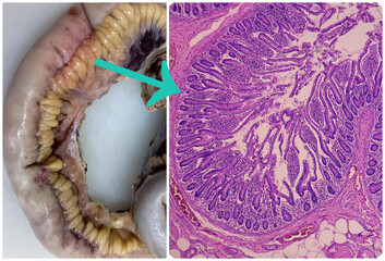 Transverse colon(biopsy): Colon and microscopic image, Fibromatosis. spindle cells with bland...