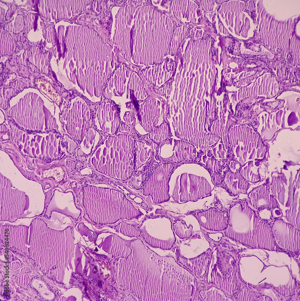 Sticker Intra abdominal mass with transverse colon(biopsy): Fibromatosis. Nodular mass show spindle cells with bland nuclei, collagen, elongated vessels and infiltration of inflammatory cells.