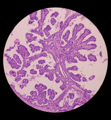 Intra abdominal mass with transverse colon(biopsy): Fibromatosis. Nodular mass show spindle cells with bland nuclei, collagen, elongated vessels and infiltration of inflammatory cells.