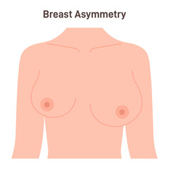 Asymmetric female breast. Different sizes of right and left boob - obrazy, fototapety, plakaty