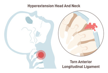 Neck hyperextension. Anterior longitudinal ligament torn. Spinal cord - obrazy, fototapety, plakaty