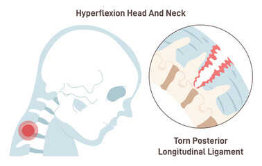 Neck hyperextension. Posterior longitudinal ligament torn. Spinal cord