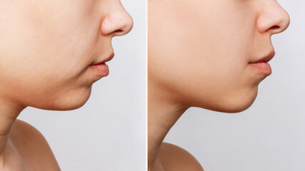 The lower part of the face of young woman with signs of skin aging before and after facelift,...