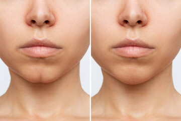 Filling the dimple on the chin with fillers. Woman's face with jaws and chin before and after dimplectomy on a white background. The result of cosmetic plastic surgery. Beauty concept. Comparison - obrazy, fototapety, plakaty