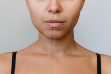 Young woman's face before and after plastic surgery buccal fat pad removal on a gray background. A lower part of face with clear highlighted cheekbones. Result of cheek surgery , comparison
