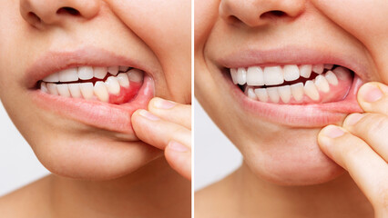 Two shots of a young woman with red bleeding gums and health gums, before and after treatment on a white background. Result of curing of gum inflammation. Close up. Dentistry, dental care. Comparison - obrazy, fototapety, plakaty
