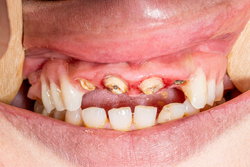 inflammatory, bleed, blood, removable partial prosthesis, examination, wooden, tongue depressor,...