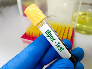 Blood sample for Monkeypox virus test. It has been rebranded 'mpox' by the World Health...