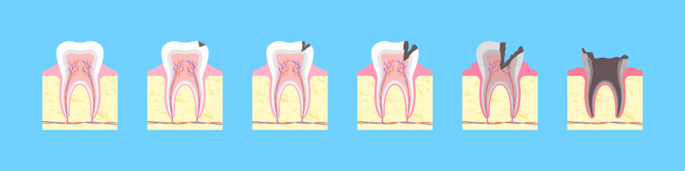 Process of carious destruction of tooth. Healthy bone formation with black fissure and gradual inflammation. Enamel decay with dental infection and complete vector loss