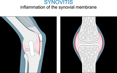 Synovitis. inflammation of the synovial membrane. Knee and Synovial joint