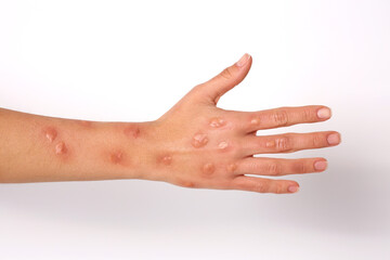 Woman with rash suffering from monkeypox virus on white background, closeup