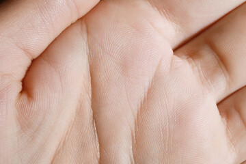 Closeup view of human hand with dry skin