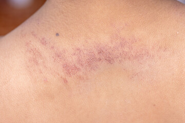 Fototapeta premium It is a dermatitis small warty bumps appear on the skin in child.