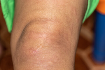 It is a dermatitis small warty bumps appear on the skin in child.