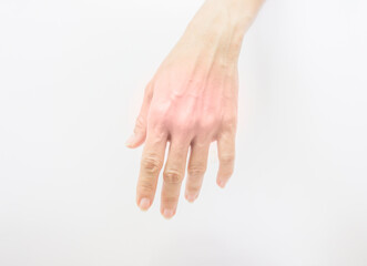 Human hand with muscle problems, inflammation, pain and swelling.