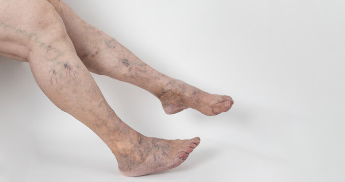 Medicine And Health. The Concept Of Female Varicose Veins. Female Profile Legs With Varicose Veins, On A White Background. VARICOSITY, Legs Of An Older Unrecognizable Woman. Copyspace.