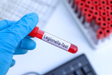 Legionella test to look for abnormalities from blood