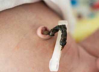 The remains of the umbilical cord in a baby after birth. Healing of the umbilical wound and...
