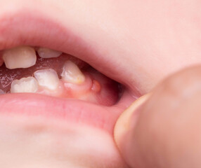 Red swelling on the gums of a child in the oral cavity. Fistula-bump due to bacteria of the...