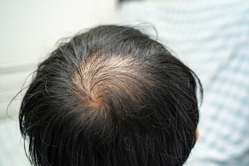 Fototapeta premium Bald in the middle head and begin no loss hair glabrous of mature Asian business smart active office man.