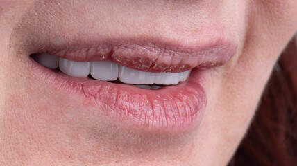 ceramic crowns and veneers