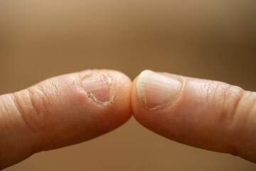 Onychophagy. Close up of fingers with eaten nail. Effects of anxiety and nerves.