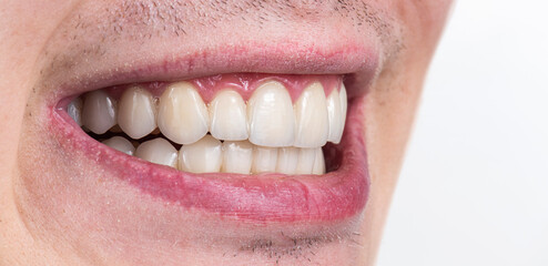 Obraz premium ceramic crowns and veneers