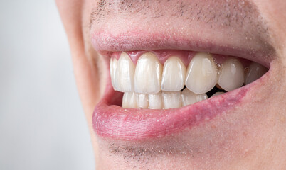 Obraz premium ceramic crowns and veneers
