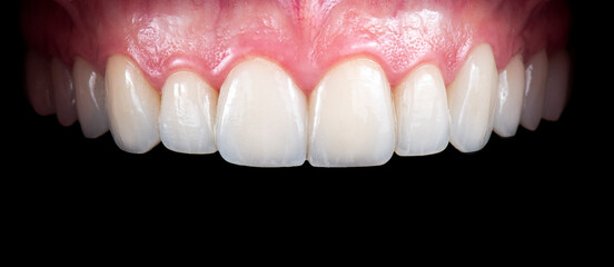 ceramic crowns and veneers