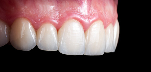 ceramic crowns and veneers