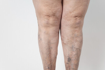 Fototapeta na wymiar Medicine and health. The concept of female varicose veins. female legs with varicose veins, on a white background.VARICOSITY,senior woman.