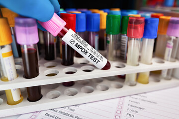 Technician with Blood collection tubes test for analysis of Smallpox and Monkeypox (MPXV). Doctor...