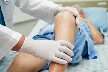 Doctor checking Asian elderly woman patient with scar knee replacement surgery in hospital.