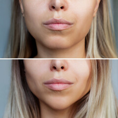 Chin reduction with fillers. Woman's face with jaws and chin before and after mentoplasty on a gray...