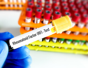 Blood sample RF (Rheumatoid factor) or RA (Rheumatoid arthritis) test, diagnosis for rheumatoid...