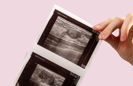 Ultrasoung image, paper of breast tumor, tissue, women health problems, cancer risk. Breast mice, fibroadenoma