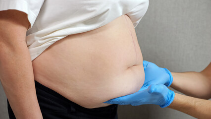 Hands of doctor in rubber gloves examine belly of female patient against grey wall. Woman with excess weight gets prepared for plastic surgery closeup