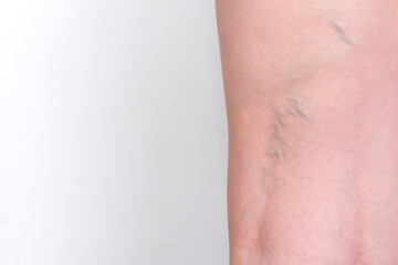 varicose veins, leg veins, back view of a woman, back view of a woman
