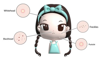 3D illustration young girl infographic showing the appearance of blackheads, pimples, pimples and pimples on a white background.