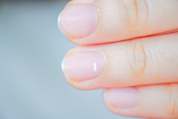White spots on finger nails called leukonychia reveal the emergence of health problems.
