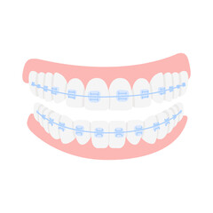 Braces for correction jaw and teeth, isolated on white background. Concept dental medecine, stomatology. Cartoon flat design. Vector illustration.
