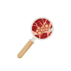 Detailed lung cancer under magnifying glass. Cartoon style illustration on white background