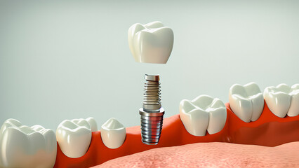 Dental surgery. Tooth implant - obrazy, fototapety, plakaty