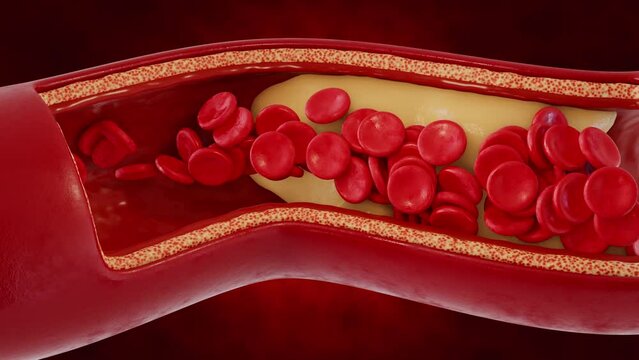 The formation of cholesterol plaques on the walls of blood vessels. 3d visualization of atherosclerosis. Medical concept.